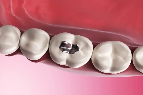 Dental Filling in Dubai